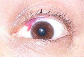 Clinical study of asymptomatic ocular conditions and symptoms in Delhi
